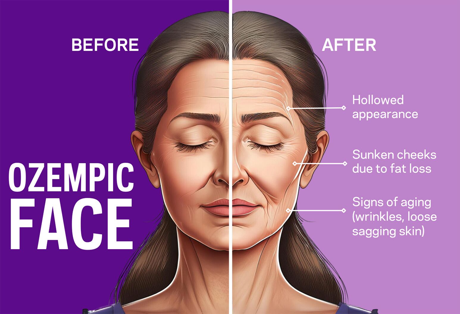 Ozempic Face What It Is How To Treat It Northwell Health