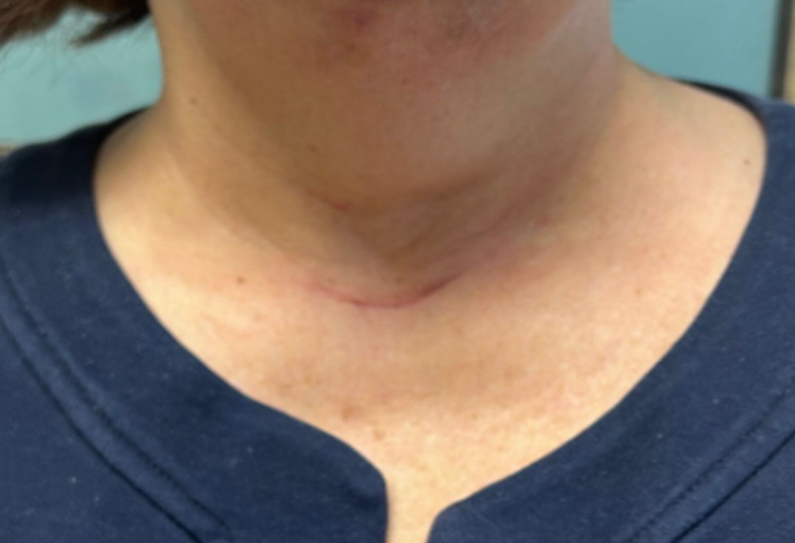 Parathyroid Incision Thyroid surgery - Westchester, New York | Northwell Health