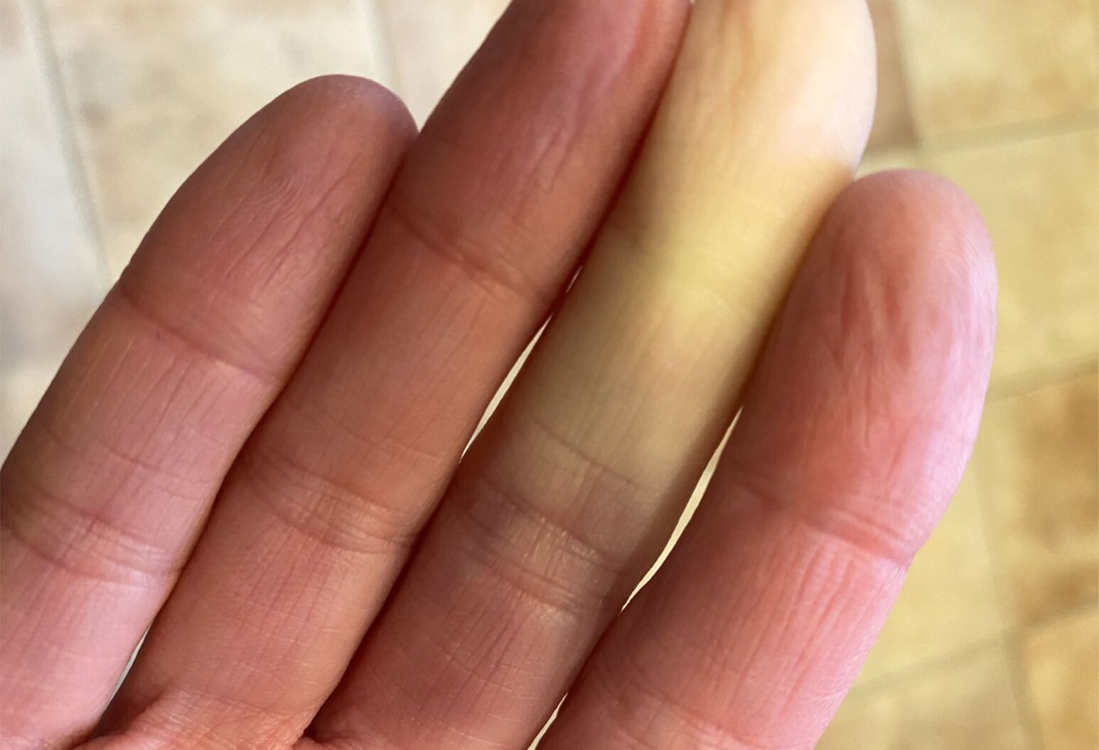 The Unique Symptoms Of Raynaud's Disease | The Well by Northwell