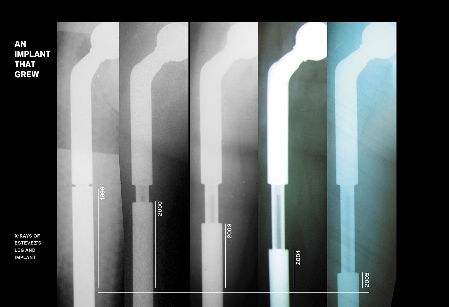 Father and son doctors save Soleidy Estevez decades apart Northwell Health