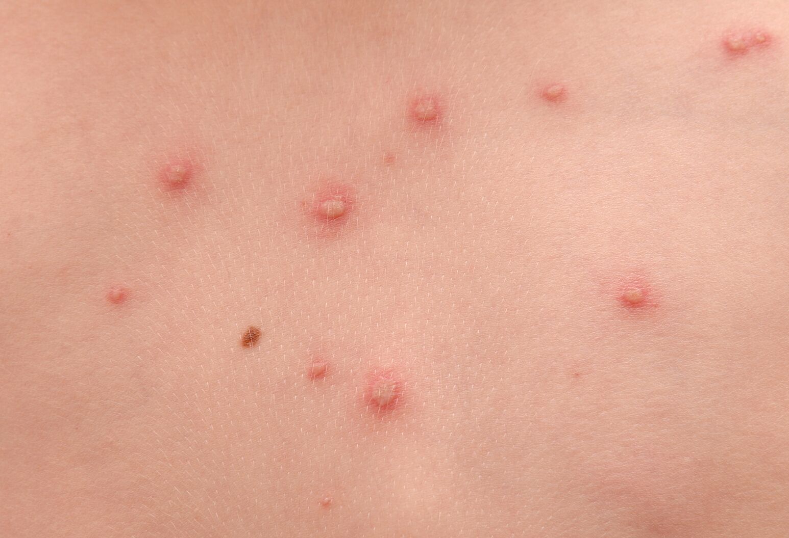 Rashes in Kids: age-by-age skin condition guide - Today's Parent