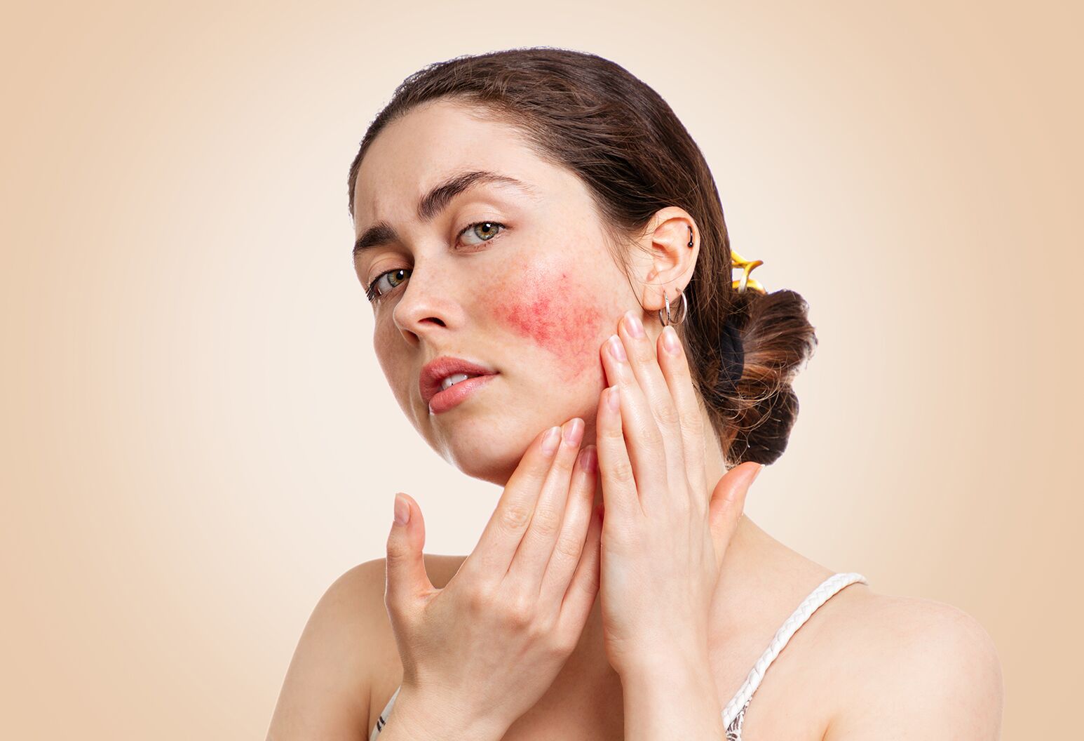 Dermatologist Recommended Treatments For Rosacea The Well By Northwell 1409