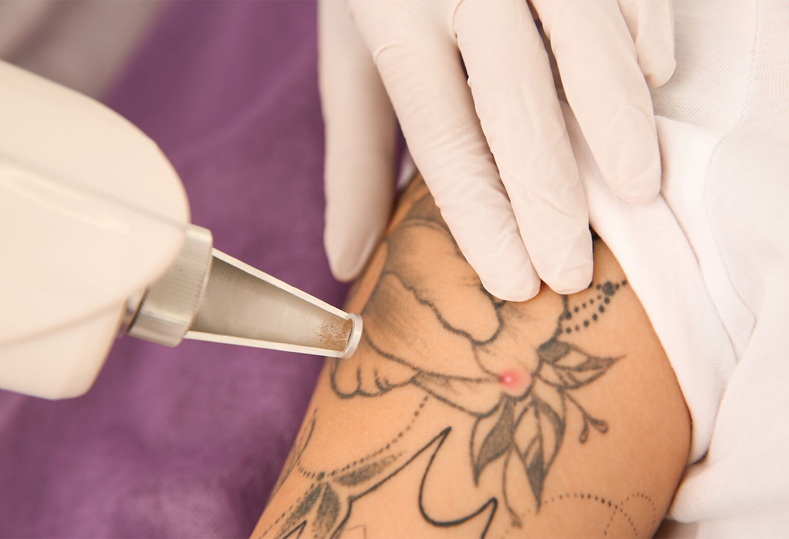 Microneedling Tattoo Removal - Fade Away Laser