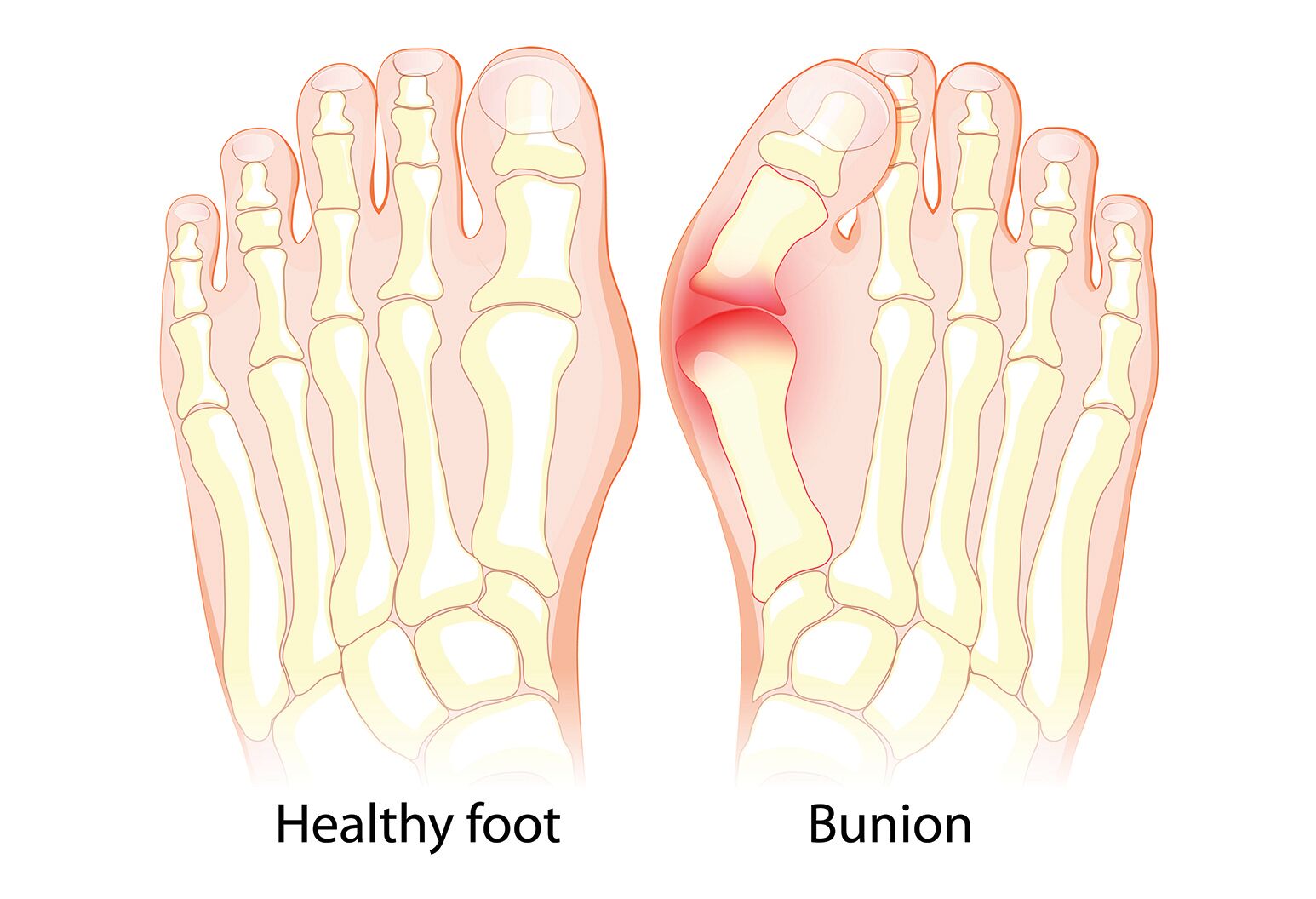 Expert Advice How To Get Rid Of Bunions The Well by Northwell