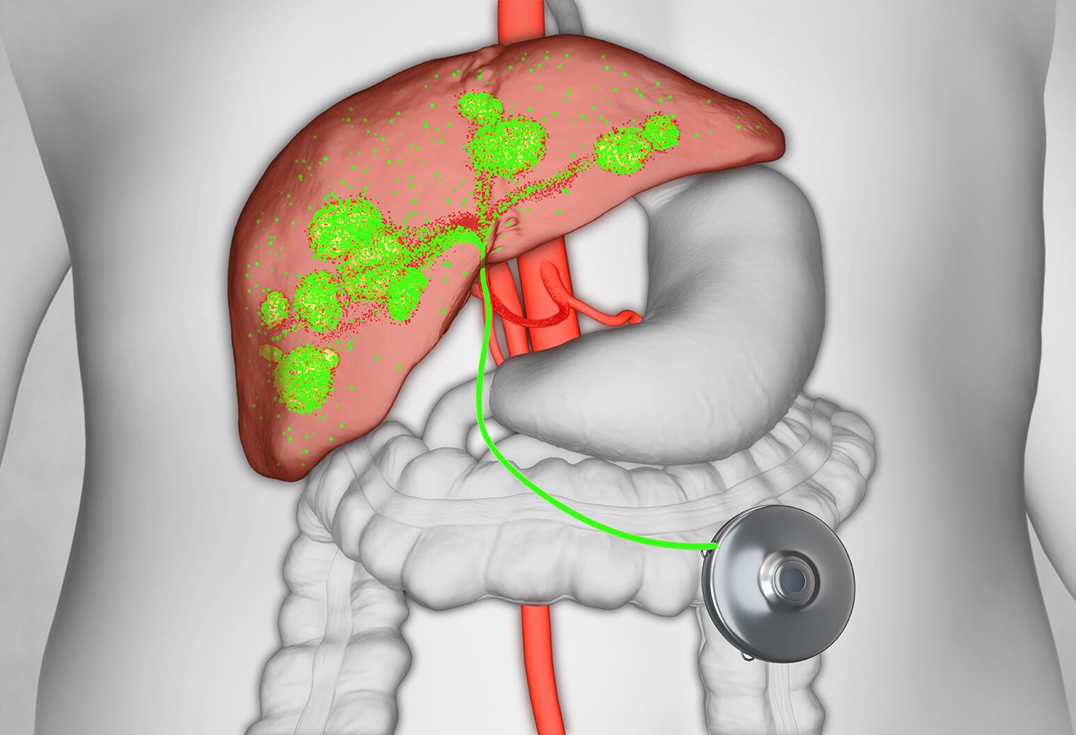 Chemo pump: Definition and how they work