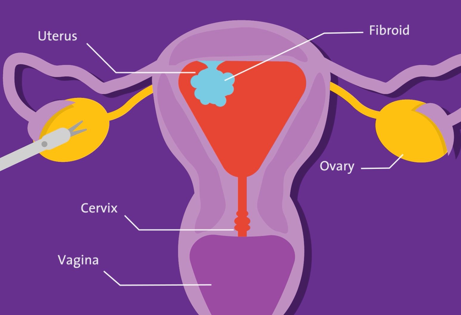 Illustration of the female reproductive tract, highlighting the uterus, fibroid, ovary, cervix and vagina. 