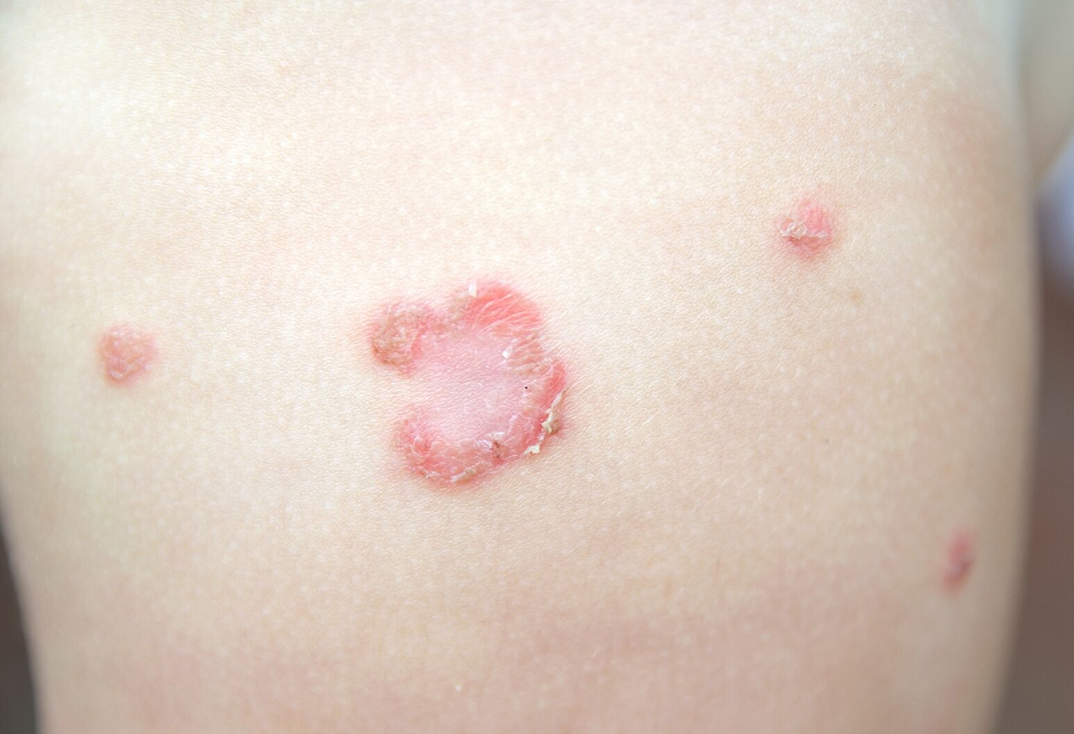 Understanding Common Rashes In Kids The Well By Northwell