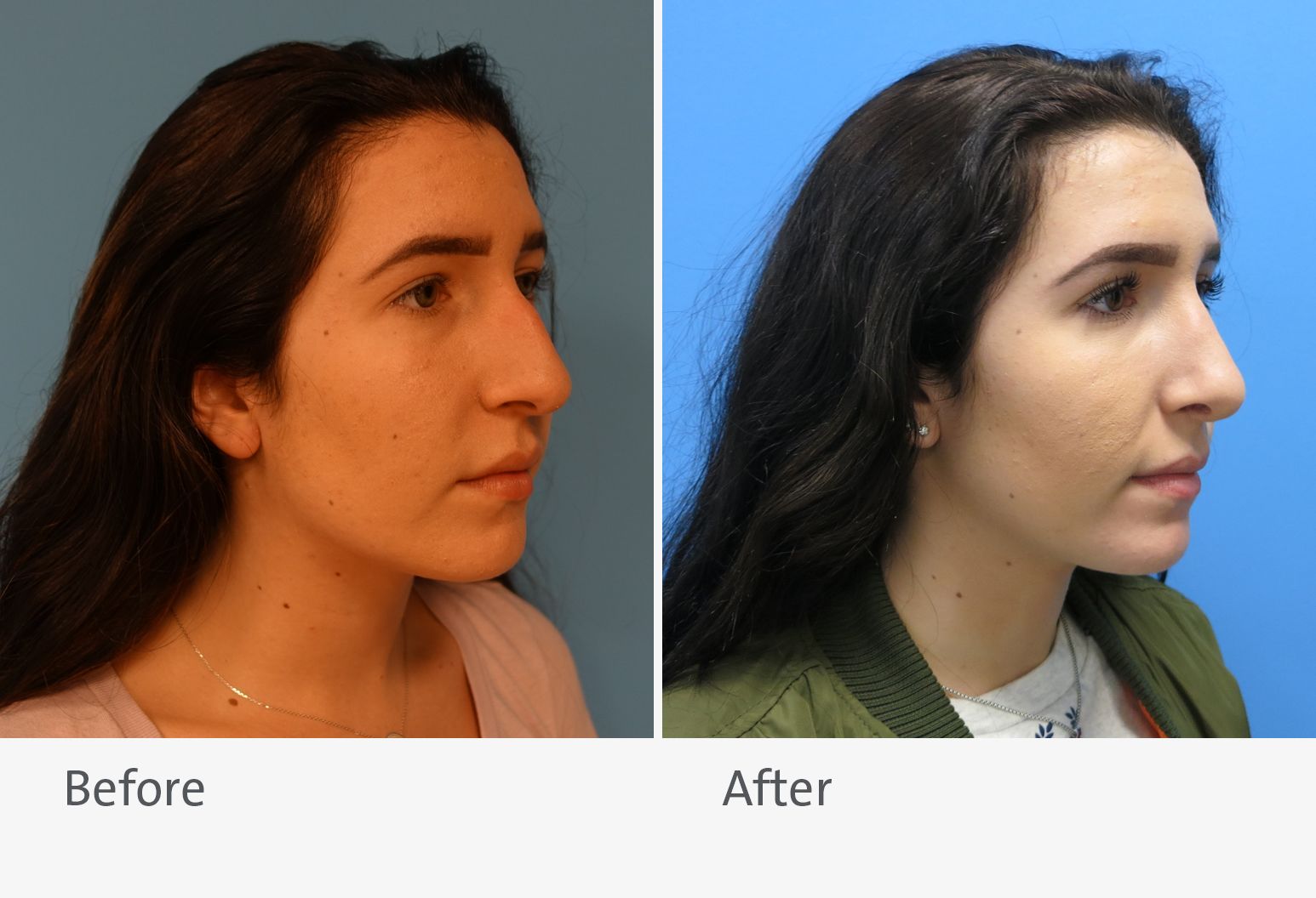 Rhinoplasty Plastic and Reconstructive Surgery Northwell Health