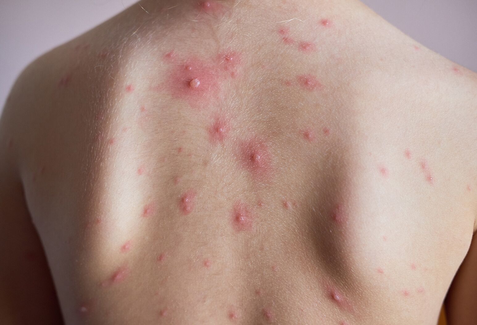 Rashes on kids: Common childhood skin rashes