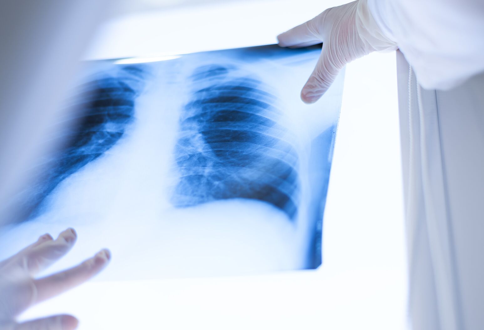 Lung Cancer Screenings Need To Gain More Attention Here s Why 