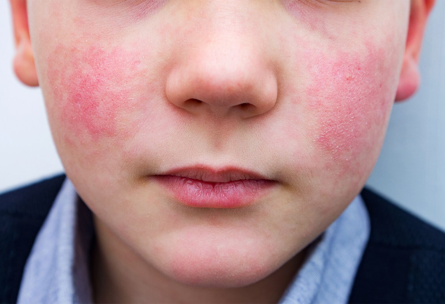 Rash On Child S Face After Swimming