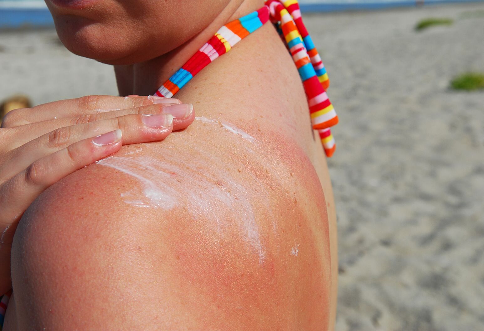 Obscured image of woman's sunburned shoulder as she applies sunscreen over her skin.