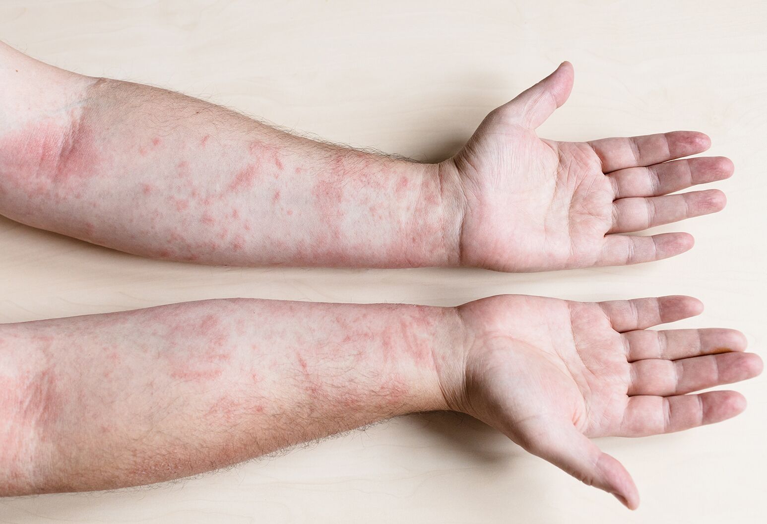 Understanding Common Rashes In Kids