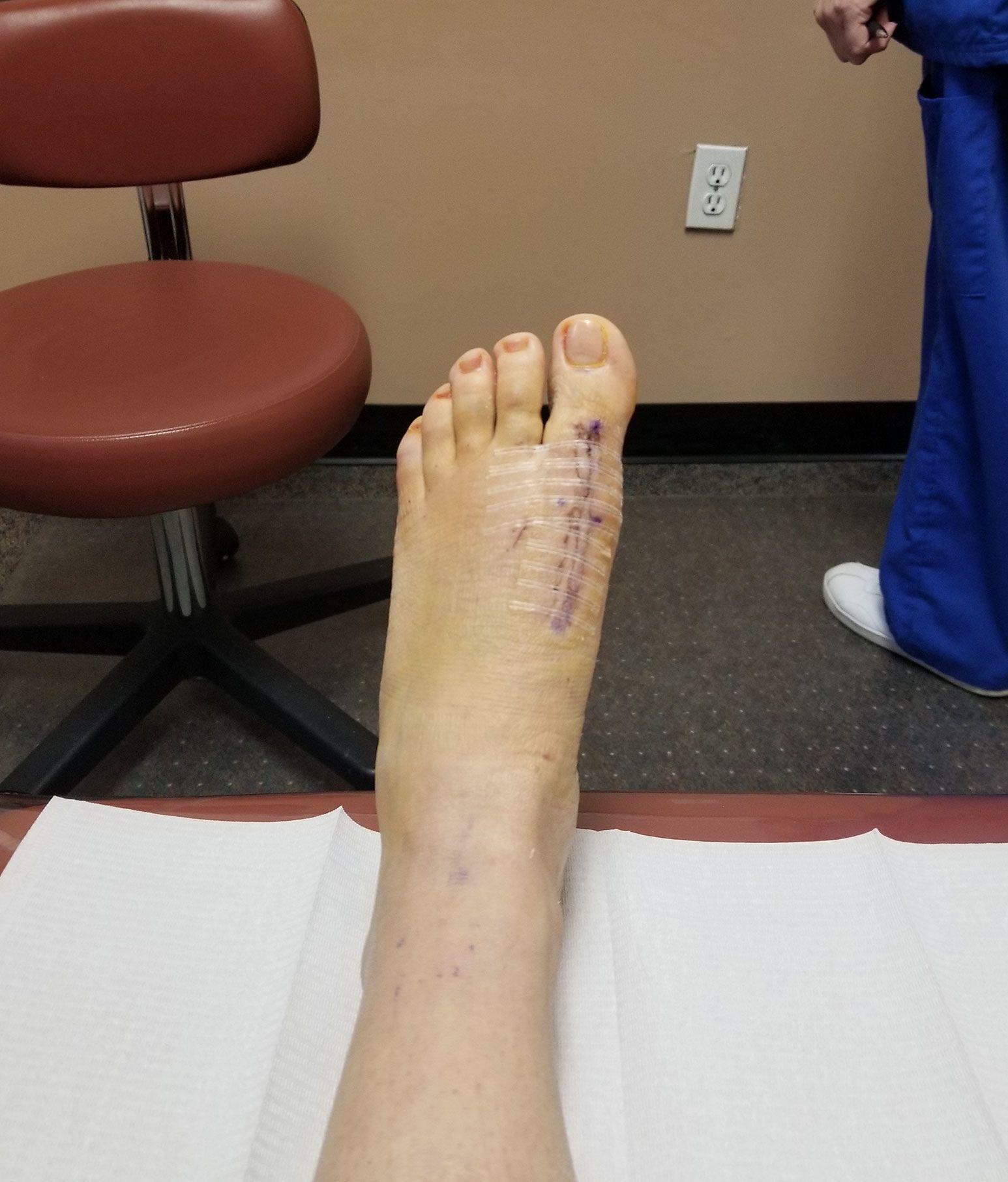 Getting Bunion Surgery